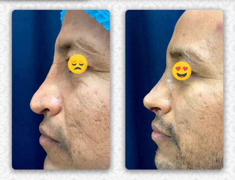 Rinoplastia secundaria