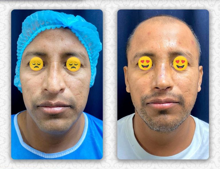 Rinoplastia secundaria