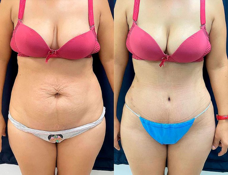 Abdominoplastia (40 días)