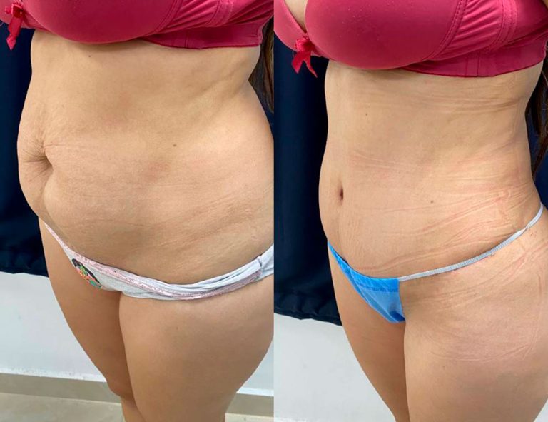 Abdominoplastia (40 días)