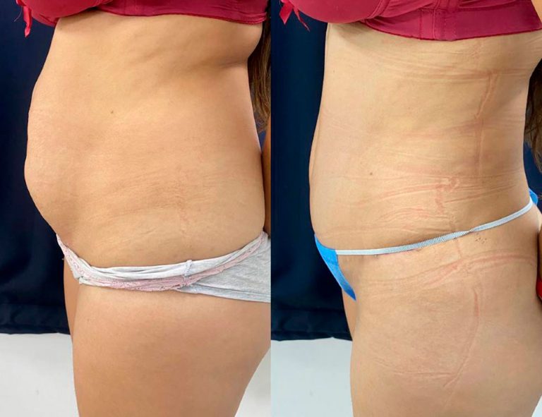 Abdominoplastia (40 días)