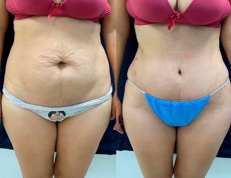 Abdominoplastia (40 días)