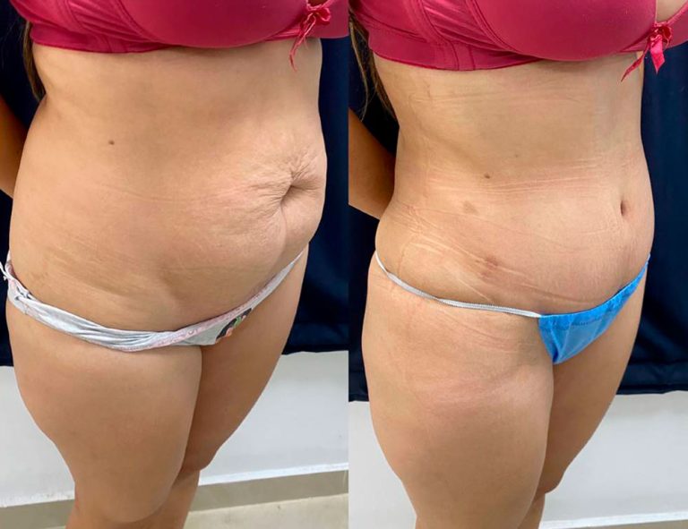 Abdominoplastia (40 días)
