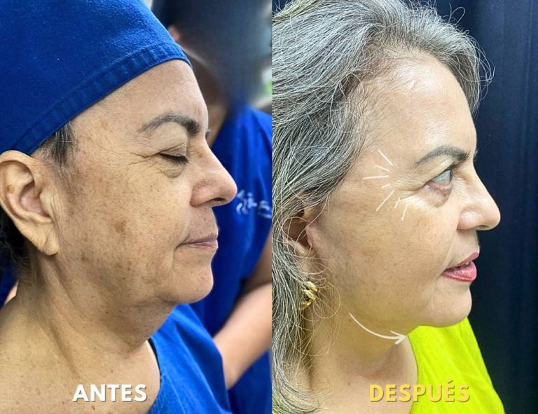 Lifting Facial Láser y Blefaroplastia (post operatorio 2 meses)