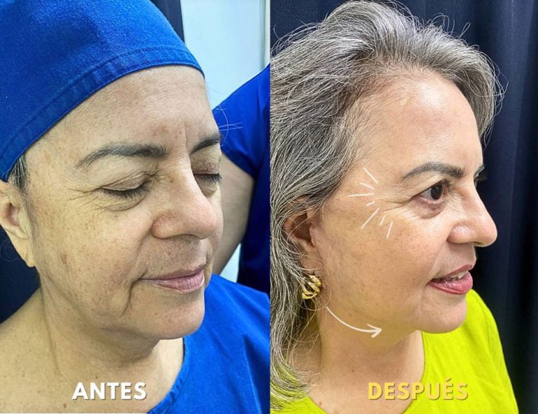 Lifting Facial Láser y Blefaroplastia (post operatorio 2 meses)