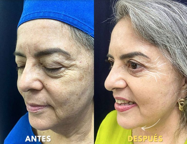 Lifting Facial Láser y Blefaroplastia (post operatorio 2 meses)