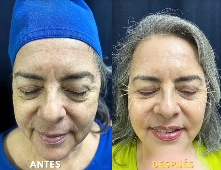 Lifting Facial Láser y Blefaroplastia (post operatorio 2 meses)