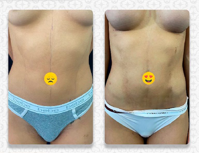Lipo HD + Aumento mamario