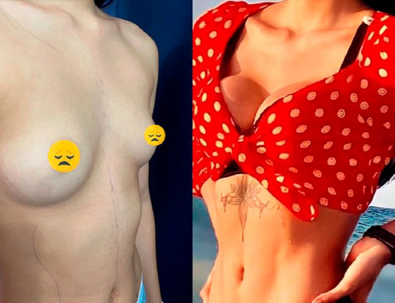 Lipo HD + Aumento mamario