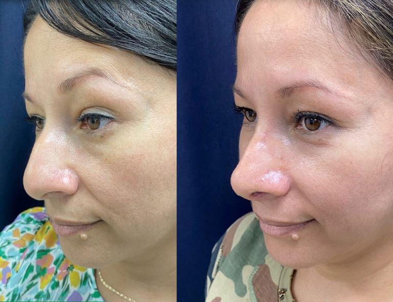 Rinoplastia (20 días)