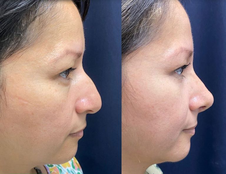 Rinoplastia (20 días)