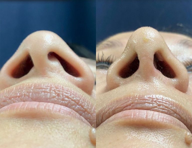 Rinoplastia (20 días)