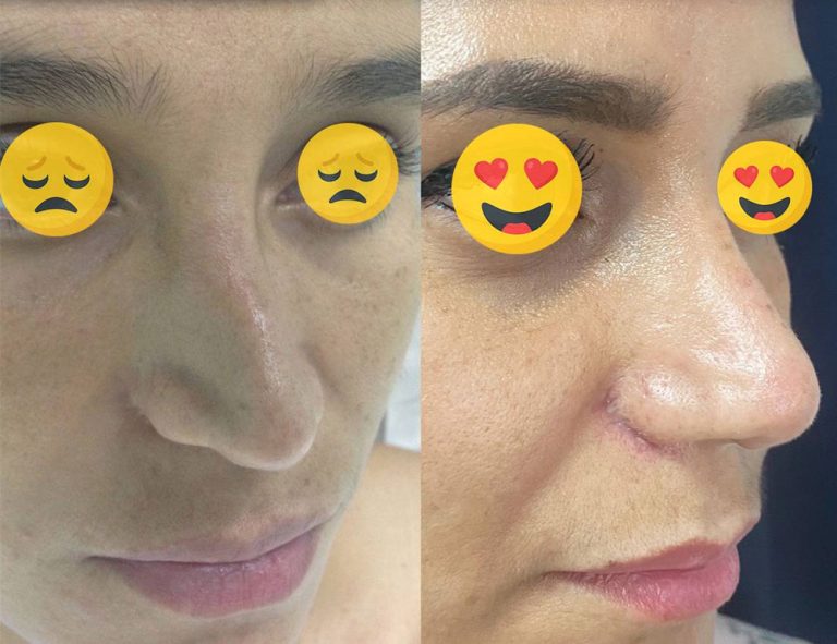 Rinoplastia secundaria