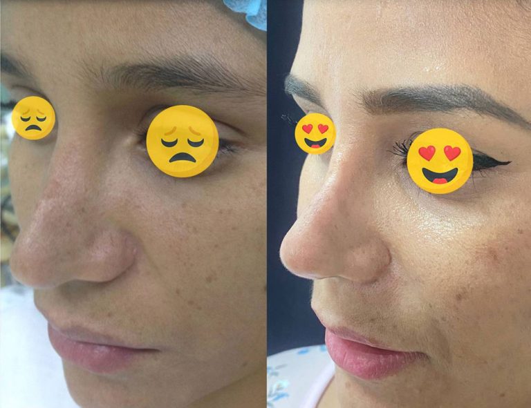Rinoplastia secundaria