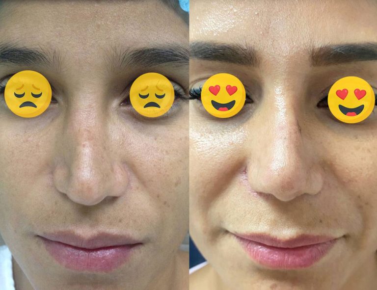 Rinoplastia secundaria