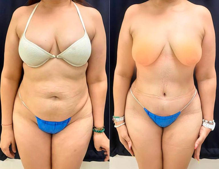 Abdominoplastia (40 días)