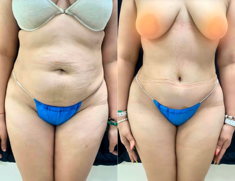Abdominoplastia (40 días)