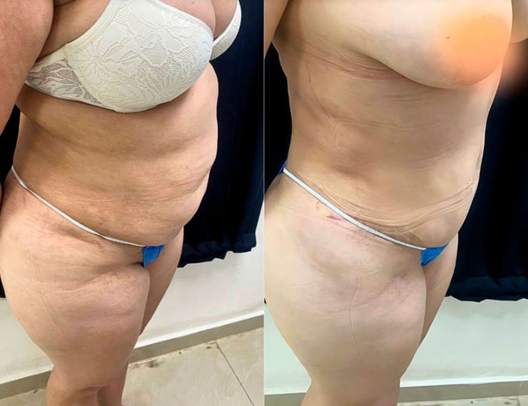 Abdominoplastia (40 días)