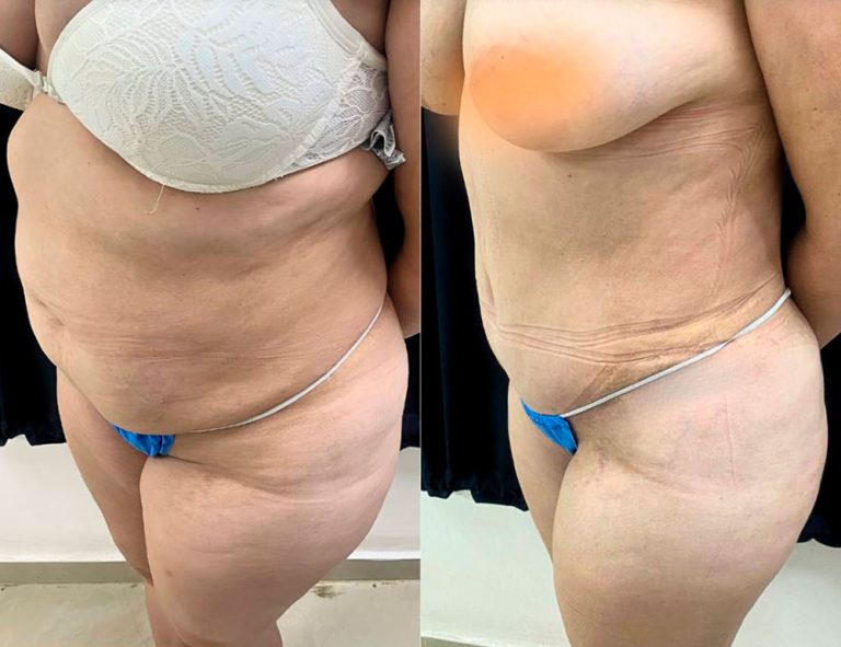 Abdominoplastia (40 días)