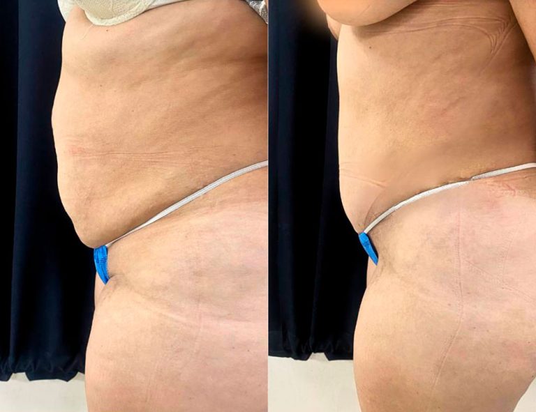 Abdominoplastia (40 días)