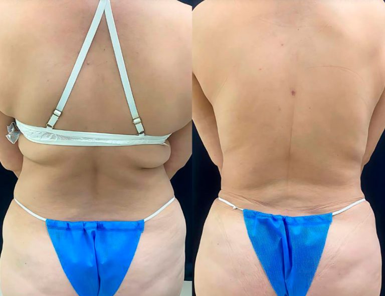 Abdominoplastia (40 días)