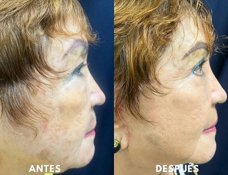 Lifting facial y blefaroplastia. (40 días post operatorio)