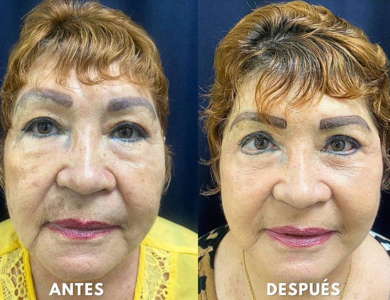 Lifting facial y blefaroplastia. (40 días post operatorio)