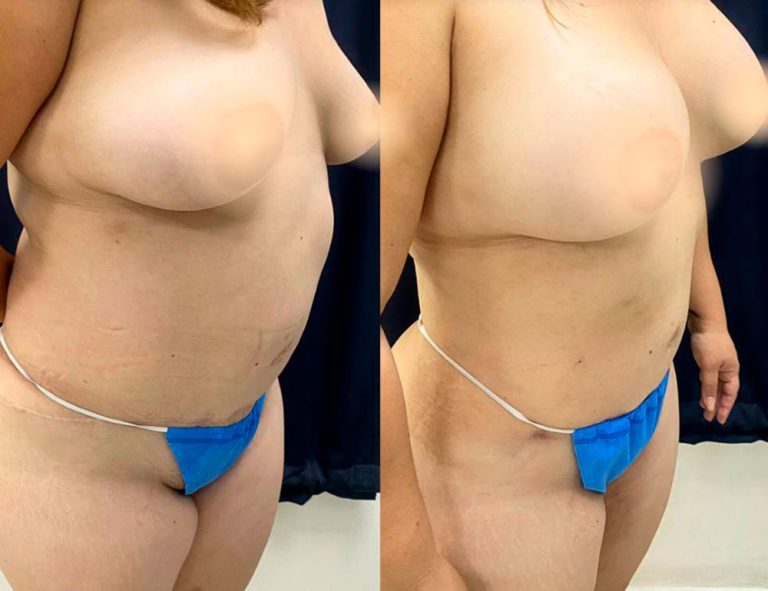 40 días de post-operatorio