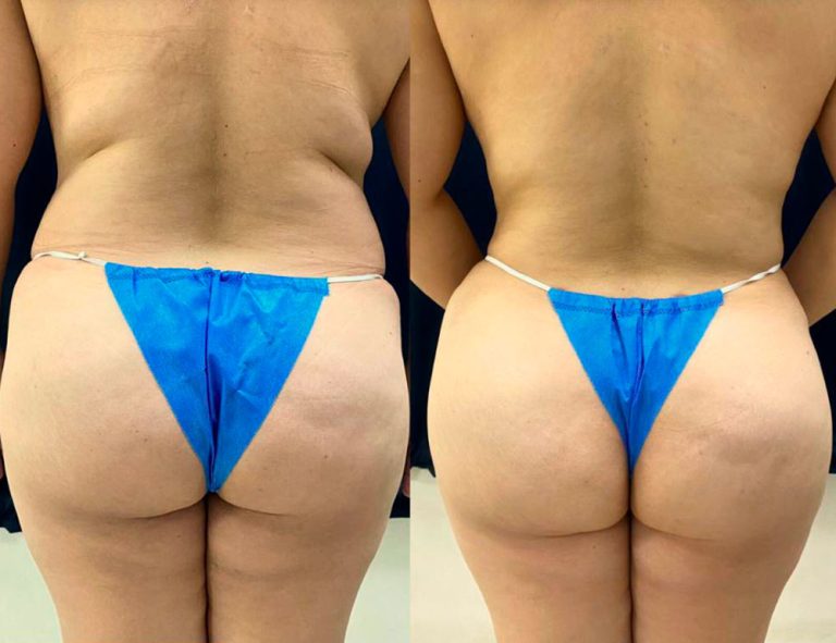 40 días de post-operatorio