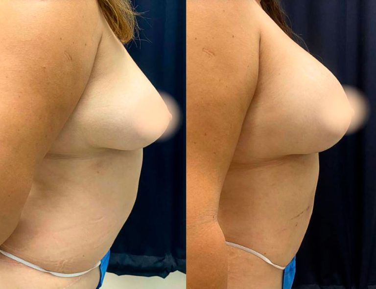 40 días de post-operatorio