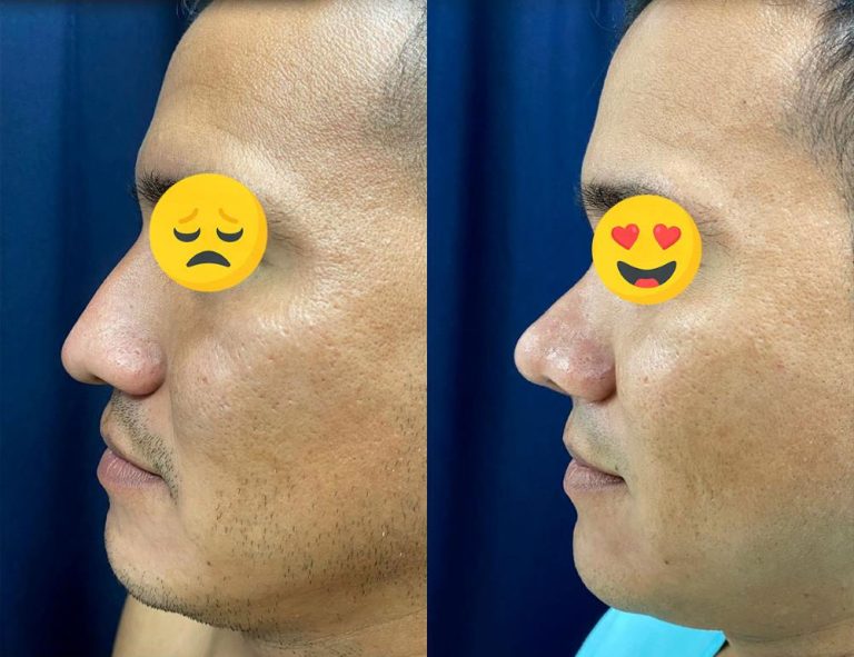 Rinoplastia (2 meses)