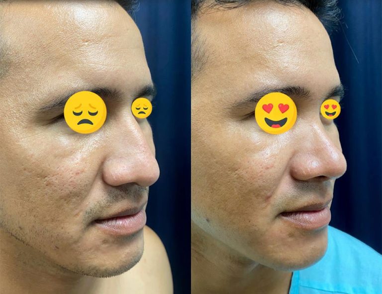 Rinoplastia (2 meses)