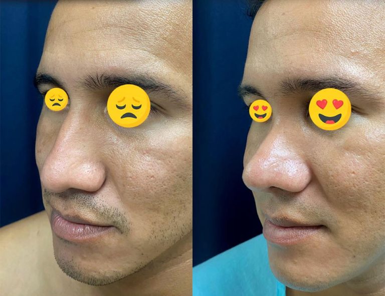 Rinoplastia (2 meses)