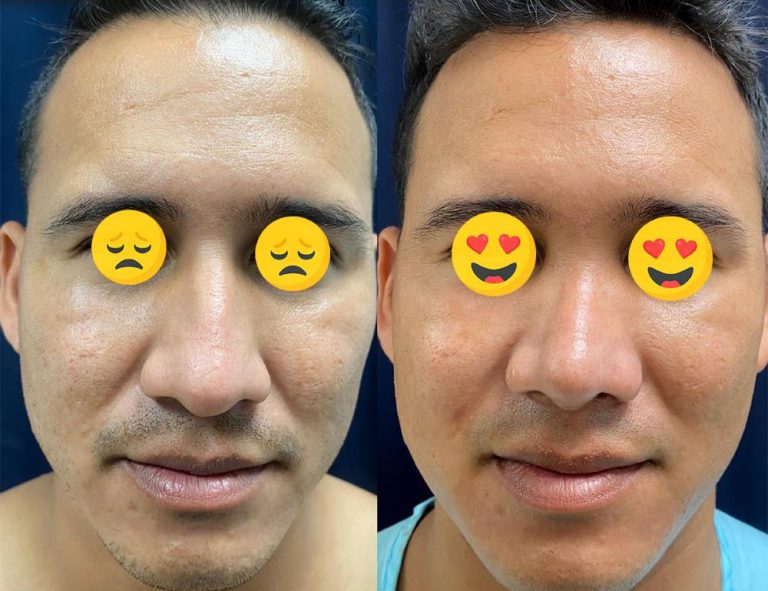 Rinoplastia (2 meses)