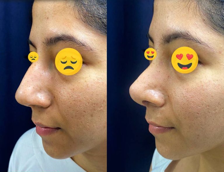 Rinoplastia (40 días)