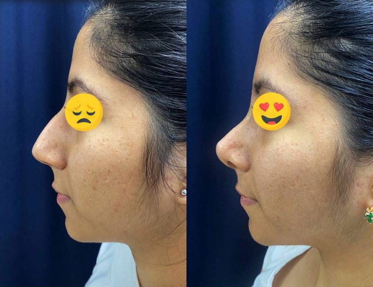 Rinoplastia (40 días)