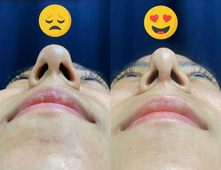 Rinoplastia (40 días)