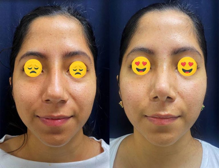 Rinoplastia (40 días)