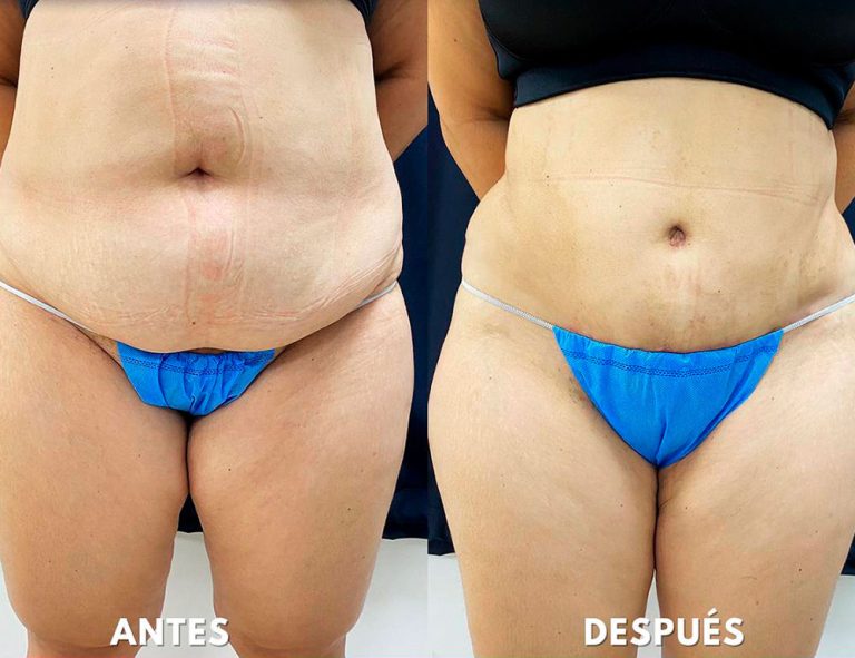 Abdominoplastia (2 meses)