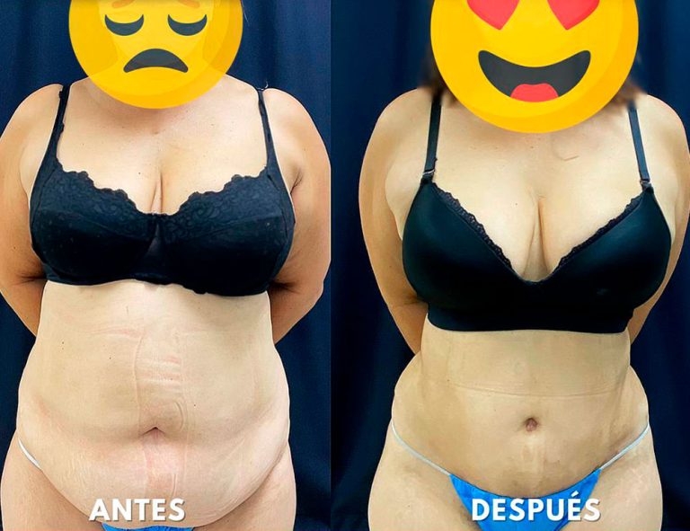 Abdominoplastia (2 meses)