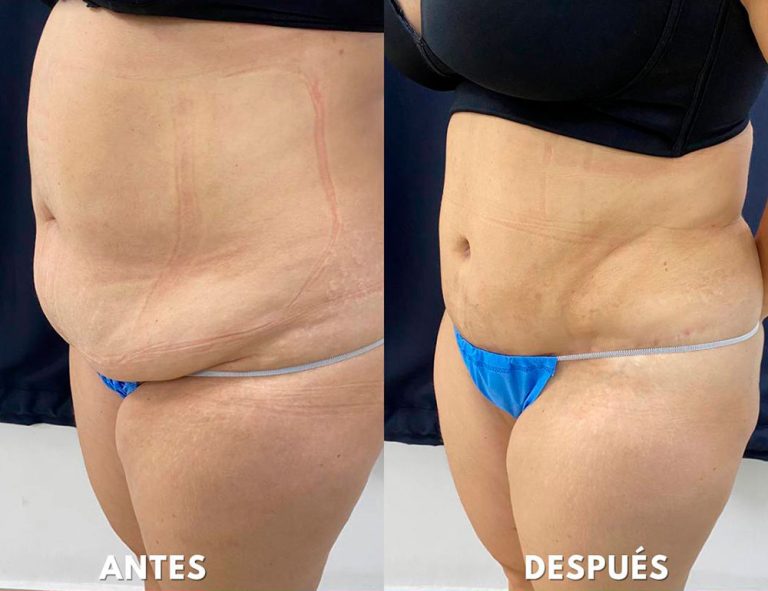 Abdominoplastia (2 meses)