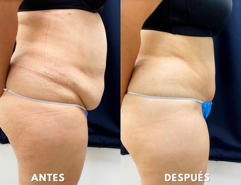 Abdominoplastia (2 meses)