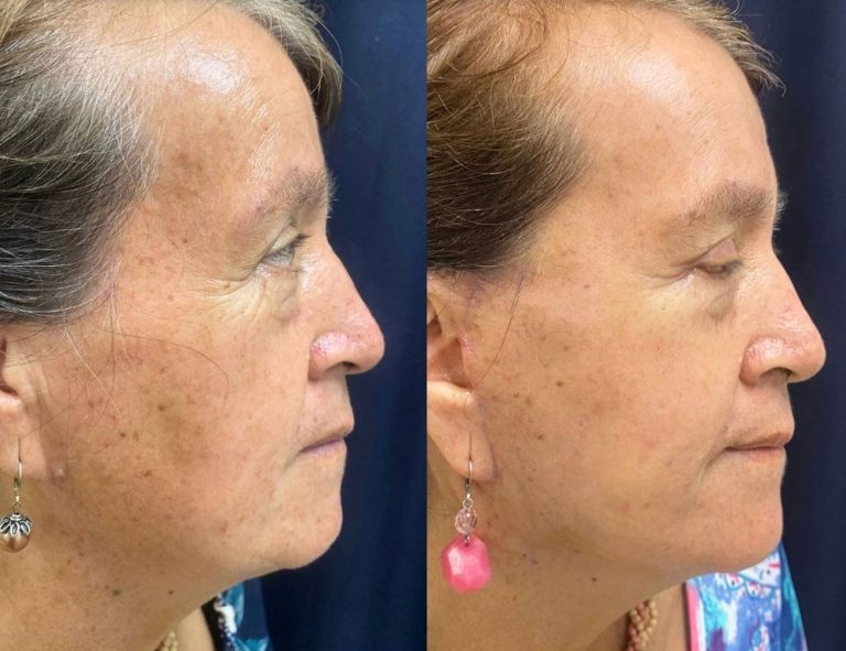 Rejuvenecimiento cérvico facial (45 días post operatorio)