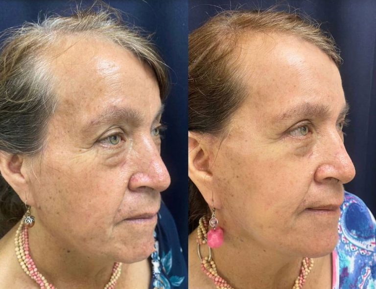 Rejuvenecimiento cérvico facial (45 días post operatorio)