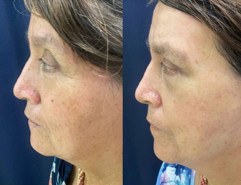 Rejuvenecimiento cérvico facial (45 días post operatorio)
