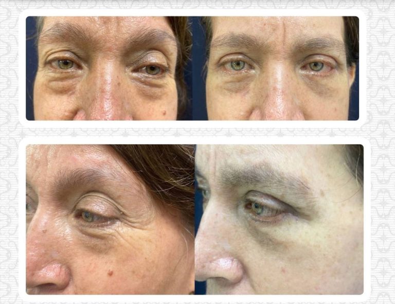 Rejuvenecimiento cérvico facial (45 días post operatorio)