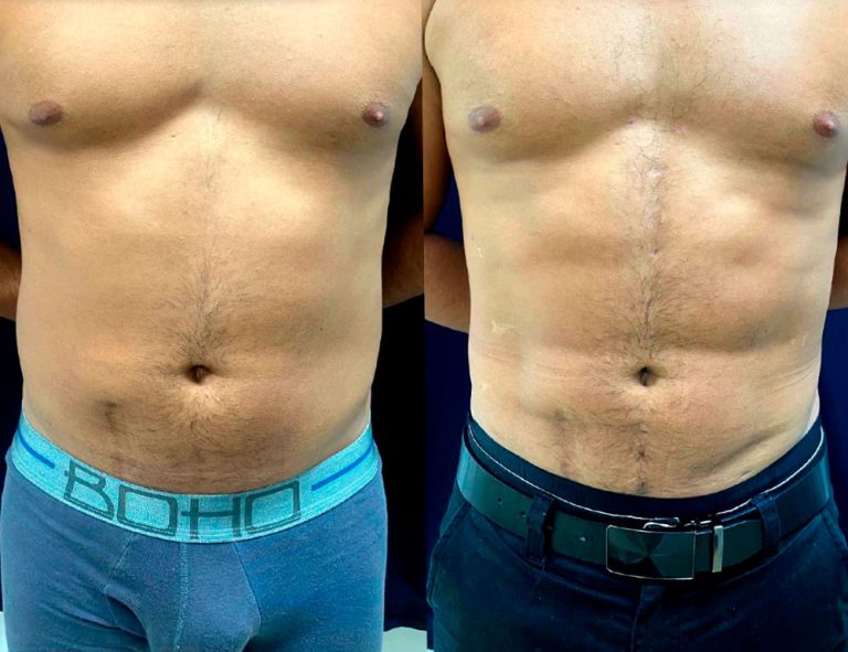 Lipoescultura HD (2 meses)