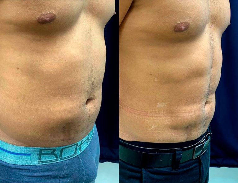 Lipoescultura HD (2 meses)