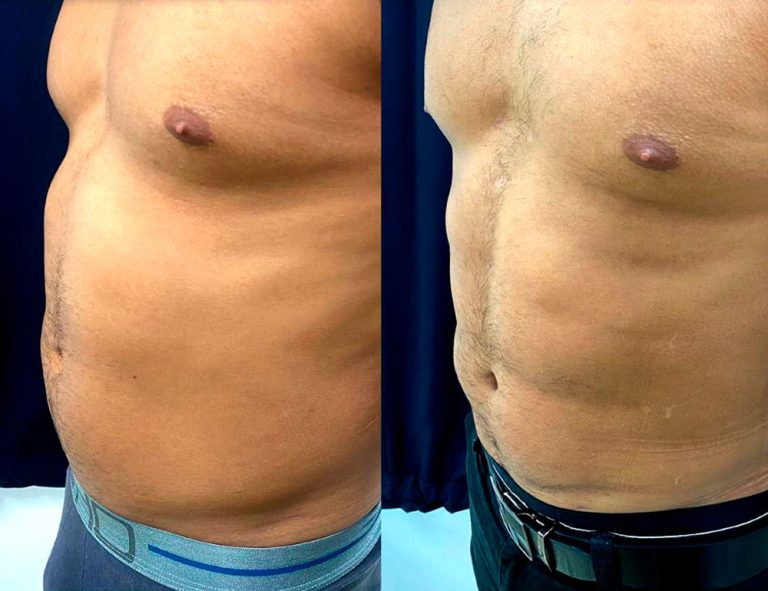 Lipoescultura HD (2 meses)