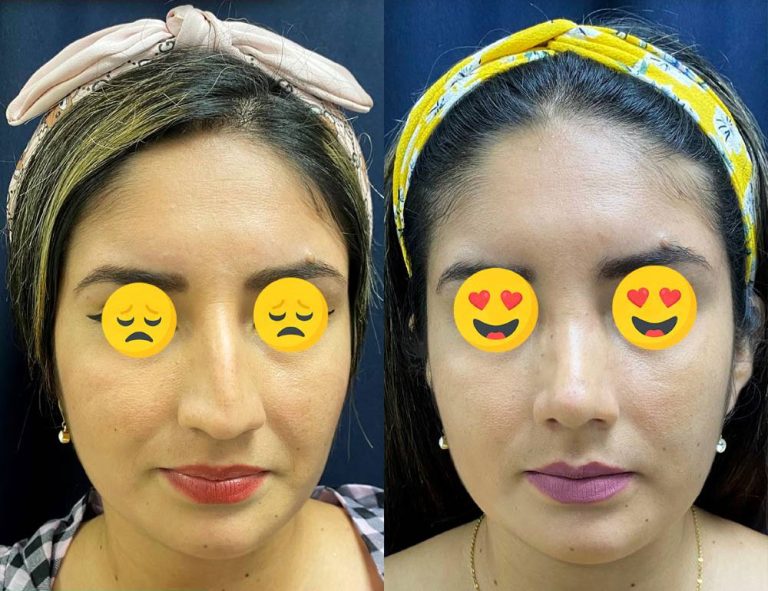 Rinoplastia (40 días)